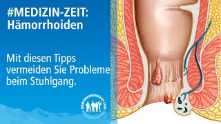 Medizinzeit Was tun bei Hämorrhoiden Stuhlgang Probleme vermeiden und Hämorrhoiden erkennen [upl. by Annaihs]