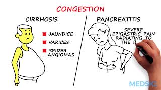 Splenomegaly Remember the 3 primary causes with CIP [upl. by Zorah]