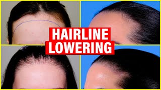 Hairline Lowering Hair Transplant vs Surgical Hairline Advancement [upl. by Eiruam748]