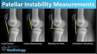 Patellar Instability  What and How to Measure [upl. by Arahd]