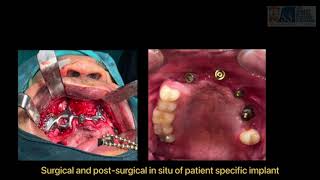 JSS DCH  Dept Prosthodontics and Crown amp Bridge  Post COVID19 Mucormycosis rehabilitation [upl. by Mordecai]