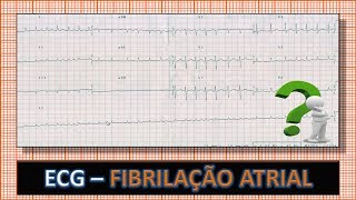 Ablação de fibrilação Atrial [upl. by Adnauqaj582]