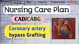 Nursing Care Plan on CABGCADNursing processNursing Diagnosis nursingcriteria [upl. by Albarran]