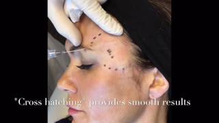 Dermal Fillers  Live Temple Augmentation With Dr Timothy R Miller MD [upl. by Yrolg]