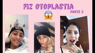 TUDO SOBRE MINHA OTOPLASTIA PARTE 2  Projeto Orelhinha [upl. by Okihcim]