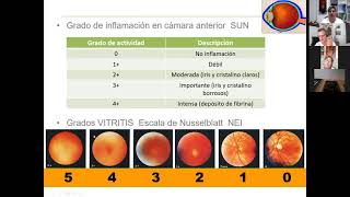 Afectación ocular en enfermedades reumáticas [upl. by Heiney]