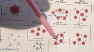 Prueba de Coombs Directo e Indirecto Hematología [upl. by Kira160]