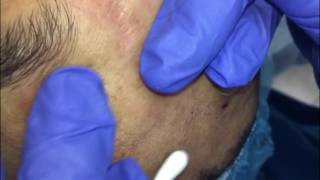 Managing Ethnic Skin extractions part 5 [upl. by Lerud]