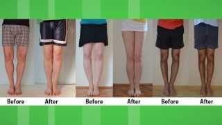 Bow Legs Correction Exercises  How to fix Bow Legs  Bow Legs Correction without surgery [upl. by Aihsirt]