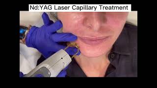 Yag Laser Capsulotomy for PCO After Cataract Surgery [upl. by Anaujd]