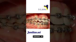 How Orthodontics Straighten teeth Braces Aligners orthodontics orthodontist dentistbonding [upl. by Einrae]