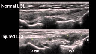 Sonographic Examination of Knee Ligaments [upl. by Sadie]