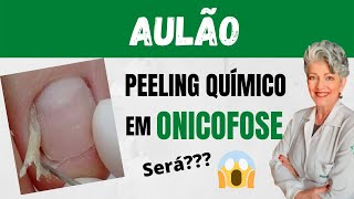 Aulão Peeling Químico em Onicofose Será que Funciona [upl. by Isayg]