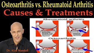 HOW TO TREAT RHEUMATOID ARTHIRITIS RA Signs and Symptoms and Management [upl. by Dena262]