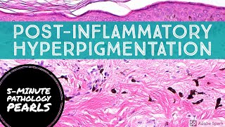 PostInflammatory Hyperpigmentation Pigment Incontinence 5Minute Pathology Pearls [upl. by Gothart458]