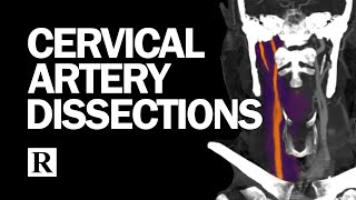 Cervical Arterial Dissections [upl. by Ydissahc]