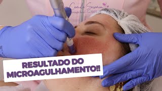 Resultados do Microagulhamento  Antes e Depois  Tratamento para Cicatriz de Acne [upl. by Ellenid217]