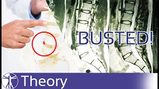 The Truth about Lumbar Disc Herniations  Myth Busting [upl. by Rowland]