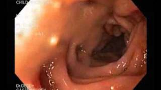 Gastroscopy  gastritis hyperemia and esophagitiswmv [upl. by Adihaj]