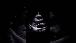 What is Attenuation echocardiography [upl. by Ardnaxela]