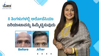 Alopecia Areata Treatment  Hair Transformation by VCare  Success Stories by VCare [upl. by Fae]