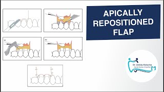 APICALLY REPOSITIONED FLAP PERIODONTAL FLAP SURGICAL TECHNIQUE DR ANKITA KOTECHA [upl. by Beutler]