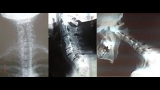 SÍNDROME DE KLIPPEL FEIL  FUSIÓN VERTEBRAL CERVICAL [upl. by Platas991]