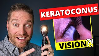 What Is Vision Like With Keratoconus And Irregular Astigmatism [upl. by Macdonell]