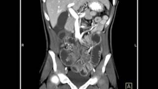 Abdomen Small Bowel EnteritisSeries of coronal sagittal volume rendered and MIP images1 of 6 [upl. by Naitsihc]