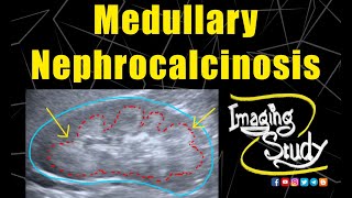 Medullary Nephrocalcinosis  Ultrasound  Case 128 [upl. by Lillywhite]