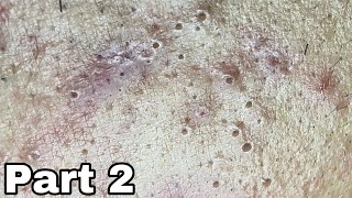 2 Blackheads for those who are addicted to watching them  BYoung Spa [upl. by Ahab]