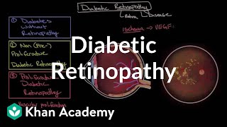 Laser Procedure for Proliferative Diabetic Retinopathy  Eye Associates of CO Springs [upl. by Shaffert]