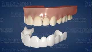 How Press On Veneers Cover Teeth [upl. by Nyrek]