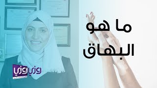 ما هو البهاق وما هي أنواعه؟ [upl. by Cchaddie]