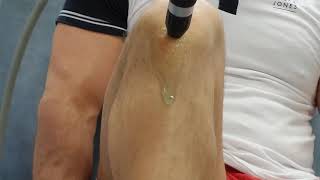 Osgood Schlatter treatment with shockwave [upl. by Snah]