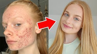 HOW I COVER MY ACNE grwm  tutorial [upl. by Claudio]