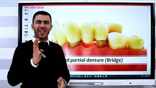 13 Fixed Prosthodontics Dental Bridge what does it means [upl. by Jany]