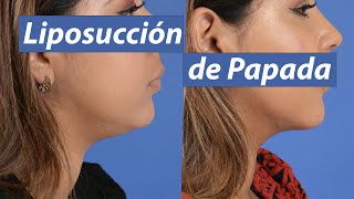 Liposucción de papada [upl. by Pederson]