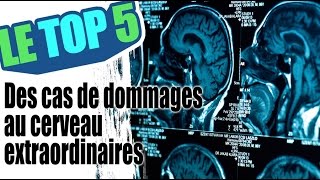 Le top 5 des cas de traumatisme au cerveau extraordinaires [upl. by Adnahsed]