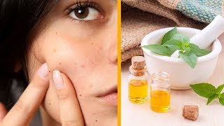 How to Use Tea Tree Oil for Acne [upl. by Cthrine]