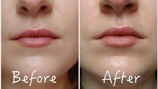 3 Ways To Permanently Enhance Lips Without Lip Injections  Before amp After [upl. by Anail]