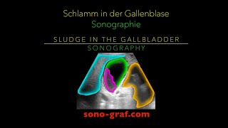 Sonographie Schlamm in der Gallenblase [upl. by Giraldo]