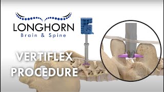 Longhorn Brain and Spine  Vertiflex Procedure [upl. by Argela541]