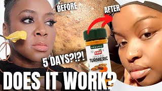 Does this DIY Turmeric Mask for Hyperpigmentation REALLY Work [upl. by Aidyn]