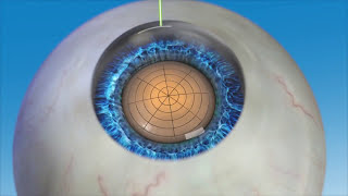 Laser Cataract Surgery with LensAR [upl. by Atiuqin]