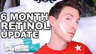 FIRST 6 MONTHS ON RETIN A  BEFORE AND AFTER TRETINOIN CREAM [upl. by Ynaffi]