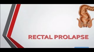 Rectal Prolapse causes and treatment – General Surgery Lecture [upl. by Oreste]