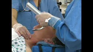 Orotracheal Intubation [upl. by Ellesij]