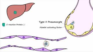 Bacterial Pneumonia  Pathogenesis [upl. by Alano5]