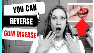 How to Reverse Gum Disease at Home [upl. by Edgardo]